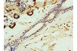 Immunohistochemistry of paraffin-embedded human breast cancer using ABIN7146290 at dilution of 1:100 (CALCB 抗体  (AA 1-127))