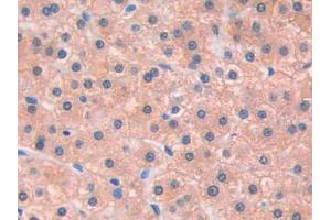 DAB staining on IHC-P; Samples: Human Liver cancer Tissue (IL13 Receptor alpha 1 抗体  (AA 203-376))