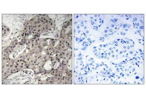 Immunohistochemistry analysis of paraffin-embedded human breast carcinoma tissue using RPL3 antibody. (RPL3 抗体  (Internal Region))