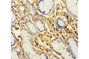 Immunohistochemistry of paraffin-embedded human gastric cancer using ABIN7164709 at dilution of 1:100 (Prokineticin Receptor 1 抗体  (AA 1-62))