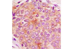 Immunohistochemical analysis of HSPE1 staining in human breast cancer formalin fixed paraffin embedded tissue section.
