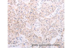 Immunohistochemistry of Human lung cancer using TYR Polyclonal Antibody at dilution of 1:30 (TYR 抗体)