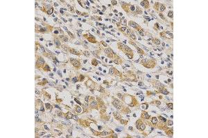 Immunohistochemistry of paraffin-embedded human stomach cancer using ERG antibody at dilution of 1:200 (x400 lens). (ERG 抗体  (AA 1-280))