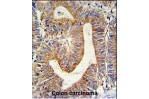 RPL17 Antibody (C-term) (ABIN653848 and ABIN2843111) IHC analysis in formalin fixed and paraffin embedded colon carcinoma followed by peroxidase conjugation of the secondary antibody and DAB staining. (RPL17 抗体  (C-Term))