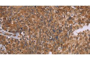 Immunohistochemistry of paraffin-embedded Human ovarian cancer using PPIB Polyclonal Antibody at dilution of 1:45 (PPIB 抗体)