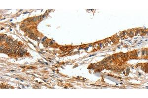 Immunohistochemistry of paraffin-embedded Human colon cancer tissue using COL1A2 Polyclonal Antibody at dilution 1:70 (COL1A2 抗体)