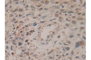 Detection of HPRT1 in Human Lung cancer Tissue using Polyclonal Antibody to Hypoxanthine Phosphoribosyltransferase 1 (HPRT1) (HPRT1 抗体  (AA 3-218))