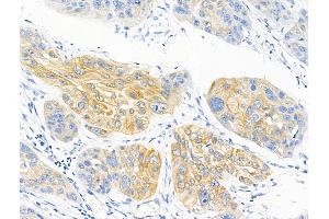 ABIN6255023 and ABIN6267139 at 1/100 staining Human esophageal cancer by IHC-P. (MFF 抗体  (pSer146, pSer172))