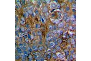 Immunohistochemical analysis of MKK1/2 staining in human prostate cancer formalin fixed paraffin embedded tissue section. (MEK1 抗体  (Center))