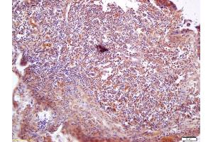 Formalin-fixed and paraffin embedded human lung carcinoma labeled with Anti-VAV3 Polyclonal Antibody, Unconjugated (ABIN706421) at 1:200 followed by conjugation to the secondary antibody and DAB staining (VAV3 抗体  (AA 701-800))