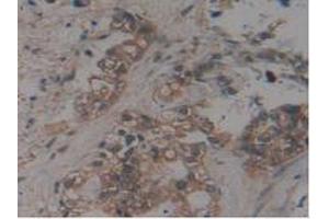 IHC-P analysis of Human Pancreas Cancer Tissue, with DAB staining. (MAPT 抗体  (AA 130-386))