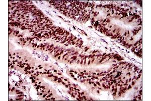 Immunohistochemical analysis of paraffin-embedded colon cancer tissues using TWIST1 mouse mAb with DAB staining. (TWIST1 抗体  (AA 9-74))