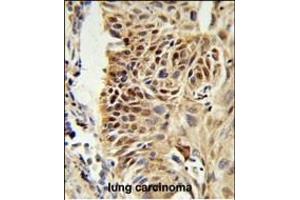 CIRBP Antibody (C-term) (ABIN653083 and ABIN2842680) IHC analysis in formalin fixed and paraffin embedded human lung carcinoma followed by peroxidase conjugation of the secondary antibody and DAB staining. (CIRBP 抗体  (C-Term))