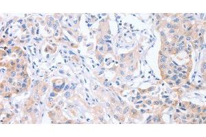 Immunohistochemistry of paraffin-embedded Human lung cancer tissue using CDCA4 Polyclonal Antibody at dilution 1:50 (CDCA4 抗体)