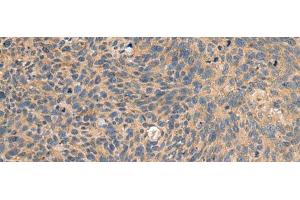 Immunohistochemistry of paraffin-embedded Human cervical cancer tissue using EIF1AX Polyclonal Antibody at dilution of 1:65(x200) (EIF1AX 抗体)