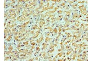 Immunohistochemistry of paraffin-embedded human liver cancer using ABIN7143181 at dilution of 1:100 (ACVR2A 抗体  (AA 20-140))