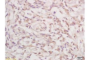 Formalin-fixed and paraffin embedded human cervical carcinoma labeled with Anti-Phospho-FGFR1+FGFR2 (Tyr463) Polyclonal Antibody, Unconjugated (ABIN758197) at 1:200 followed by conjugation to the secondary antibody and DAB staining (FGFR1/FGFR2 抗体  (pTyr463, pTyr466))