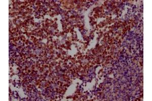 IHC image of ABIN7127596 diluted at 1:100 and staining in paraffin-embedded human lung cancer performed on a Leica BondTM system. (Recombinant XRCC5 抗体)