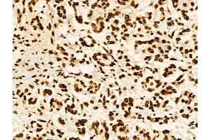 Phospho-Hexokinase 1 (Tyr732) Antibody at 1/100 staining Human pancreatic cancer and adjacent nomal tissues by IHC-P. (Hexokinase 1 抗体  (pTyr732))