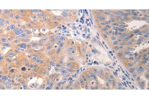 Immunohistochemistry of paraffin-embedded Human breast cancer tissue using CK-6A/B/C Polyclonal Antibody at dilution 1:50 (CK-6A/B/C 抗体)