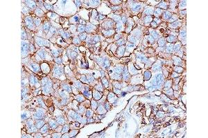 IHC testing of human breast cancer stained with HCAM antibody (156-3C11). (CD44 抗体)