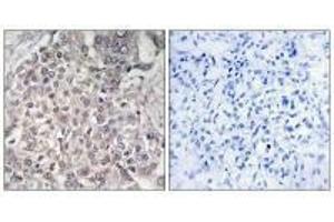 Immunohistochemistry analysis of paraffin-embedded human liver carcinoma tissue using Cytochrome P450 4F2 antibody. (CYP4F2 抗体  (N-Term))