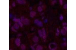 Immunofluorescence analysis of Human breast cancer tissue using Oct-1/2 Monoclonal Antibody at dilution of 1:200. (Oct-1/2 抗体)