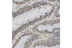 Immunohistochemistry of paraffin-embedded human rectal cancer using Trimethyl-Histone H3-K4 antibody (ABIN5969804) at dilution of 1/200 (40x lens). (Histone 3 抗体  (H3K4me3))