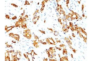 Formalin-fixed, paraffin-embedded human Breast Carcinoma stained with HSP27 Monoclonal Antibody (HSPB1/774) (HSP27 抗体)