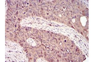 Immunohistochemical analysis of paraffin-embedded cervical cancer tissues using CCNA2 mouse mAb with DAB staining. (Cyclin A 抗体  (AA 105-233))
