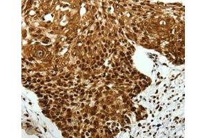 Immunohistochemical analysis of paraffin-embedded Human cervical cancer tissue using at dilution 1/40.