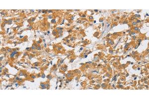 Immunohistochemistry of paraffin-embedded Human thyroid cancer using ARHGAP15 Polyclonal Antibody at dilution of 1:50 (ARHGAP15 抗体)