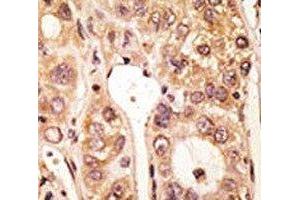 IHC analysis of FFPE human hepatocarcinoma tissue stained with the TLR5 antibody (TLR5 抗体  (AA 825-856))