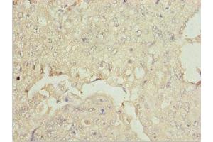 Immunohistochemistry of paraffin-embedded human lung cancer using ABIN7176007 at dilution of 1:100 (ZNF187 抗体  (AA 239-478))