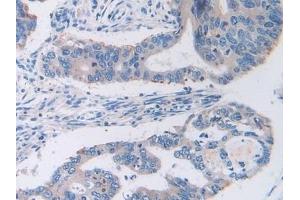 Detection of TFR in Human Colorectal cancer Tissue using Polyclonal Antibody to Transferrin Receptor (TFR) (Transferrin Receptor 抗体  (AA 567-744))