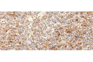 Immunohistochemistry of paraffin-embedded Human liver cancer using ZNF365 Polyclonal Antibody at dilution of 1/20 (ZNF365 抗体)