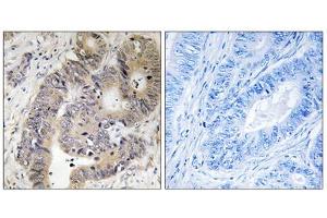 Immunohistochemistry analysis of paraffin-embedded human colon carcinoma tissue using CAD (Phospho-Thr456) antibody. (CAD 抗体  (pThr456))