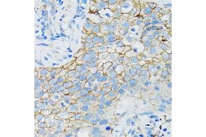 Immunohistochemistry of paraffin-embedded human lung cancer using CTNNA1 antibody (ABIN1876836) at dilution of 1:100 (40x lens). (CTNNA1 抗体)