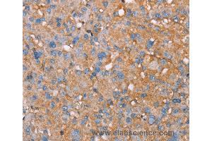 Immunohistochemistry of Human liver cancer using PAGE5 Polyclonal Antibody at dilution of 1:55 (PAGE5 抗体)