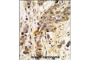 Formalin-fixed and paraffin-embedded human breast carcinoma tissue reacted with IARS2 antibody (Center) , which was peroxidase-conjugated to the secondary antibody, followed by DAB staining. (IARS2 抗体  (AA 600-628))