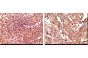 Immunohistochemical analysis of paraffin-embedded human bladder carcinoma (left) and breast carcinoma (right), showing nuclear and cytoplasmic localization using SRA mouse mAb with DAB staining. (SRA1 抗体)