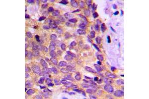 Immunohistochemical analysis of PRKAR1B staining in human breast cancer formalin fixed paraffin embedded tissue section. (PRKAR1B 抗体  (Center))