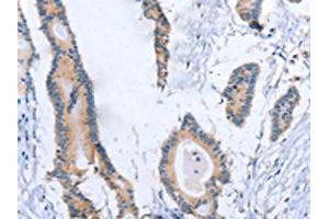 The image on the left is immunohistochemistry of paraffin-embedded Human colon cancer tissue using ABIN7189998(BOD1 Antibody) at dilution 1/30, on the right is treated with synthetic peptide. (BOD1 抗体)