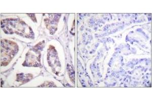 Immunohistochemistry analysis of paraffin-embedded human breast carcinoma tissue, using Vinculin (Ab-821) Antibody. (Vinculin 抗体  (AA 786-835))