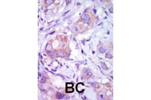 Formalin-fixed and paraffin-embedded human cancer tissue reacted with the primary antibody, which was peroxidase-conjugated to the secondary antibody, followed by DAB staining. (MAP3K9 抗体  (C-Term))