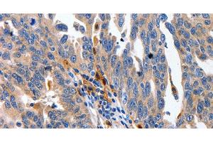 Immunohistochemistry of paraffin-embedded Human ovarian cancer using IL18 Polyclonal Antibody at dilution of 1:100 (IL-18 抗体)