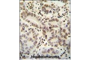 HIST1H2B antibody (Center) (ABIN654684 and ABIN2844377) immunohistochemistry analysis in formalin fixed and paraffin embedded human hepatocarcinoma followed by peroxidase conjugation of the secondary antibody and DAB staining. (HIST1H2BJ 抗体  (AA 57-86))
