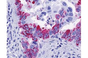 Anti-FFAR2 / GPR43 antibody IHC of human Pancreas, Carcinoma. (FFAR2 抗体  (Cytoplasmic Domain))