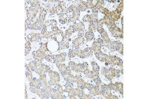 Immunohistochemistry of paraffin-embedded human liver injury using TSG101 antibody (ABIN5999112) at dilution of 1/100 (40x lens). (TSG101 抗体)