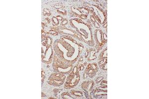 Anti-TNFAIP8L3 antibody, IHC(P) IHC(P): Human Intestinal Cancer Tissue (TNFAIP8L3 抗体  (C-Term))